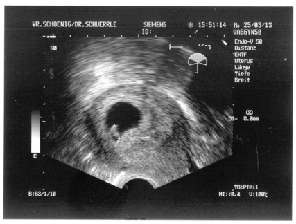 Ultrasound 25Mar2013 - 7 weeks